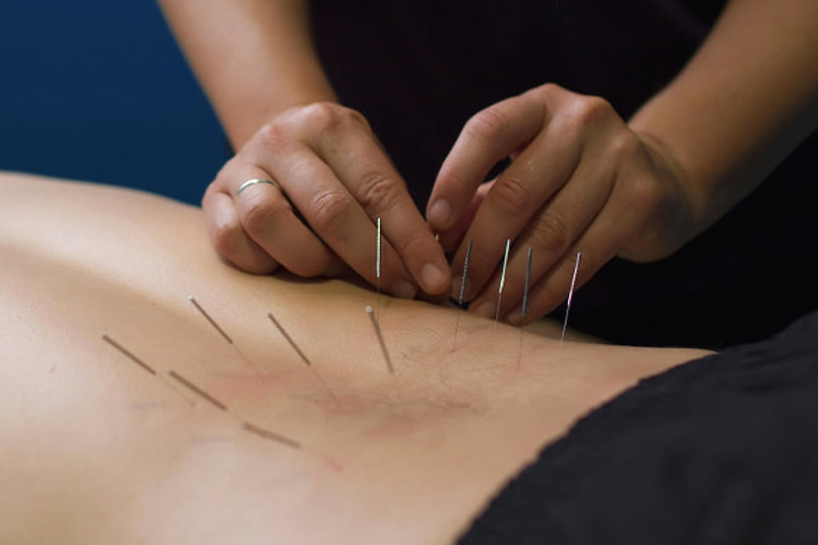 Dry Needling & Cupping Therapy Springfield NJ